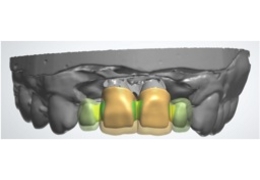 Rehabilitación anterior sobre 2 implantes