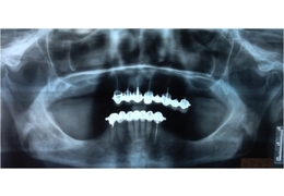 Rehabilitación sobre 6 implantes