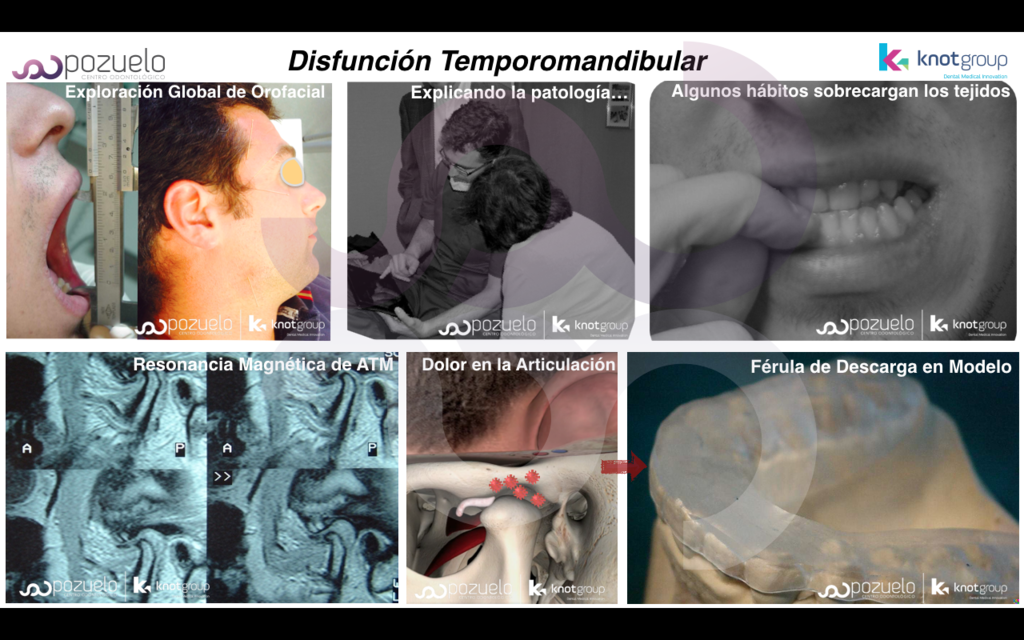 Disfunción Temporomandibular