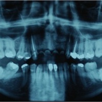 Tras las extracciones dentales y la eliminación de la lesión quiística serellena el defecto óseo con material de injerto para la regeneración ósea y se colocan provisonales de resina reforzados con fibra fijos. Por lo que el paciente nunca estuvo sin dien