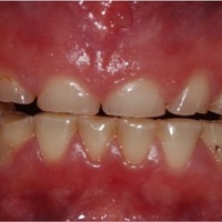 Paciente de 41 años que acude con gran desgaste dentario de origen  múltiple y dolor bucal asociado. Tanto la función oral como la estética de la paciente están comprometidas