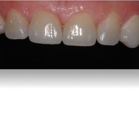 Rehabilitación superior colocada mediante adhesión química. Tras la consecución superior se procedió a preparar los dientes inferiores que se encontraban en un estado similar al de los dientes superiores
