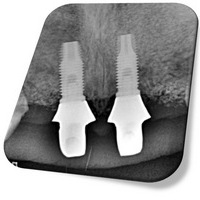 Trasncurrido el periodo de osteointegración de los impalntes, se confeccionó una prótesis fija, sobre los implantes, para conformar los tejidos del sector anterior… 