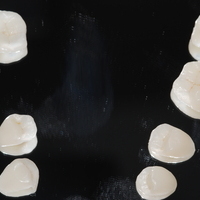 Overlays en resina nanohíbrida para respetar la máxima estructura dentaría.